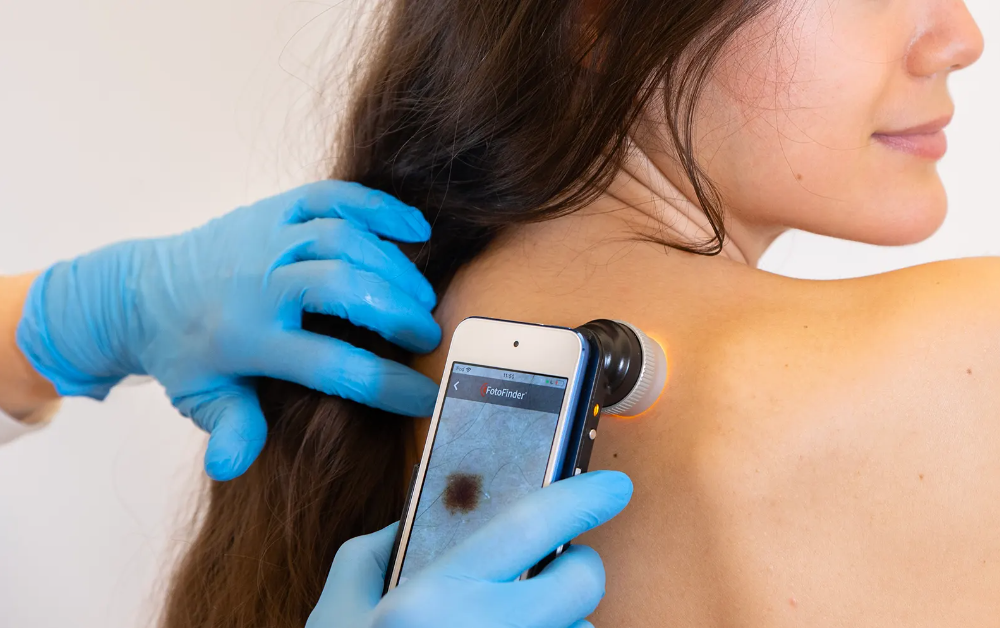 Fotofinder dépistage cancer peau - 54 Batignolles